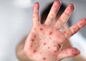 Kujdes nga lia e majmunit, OBSH-ja e shpall emergjencë globale!