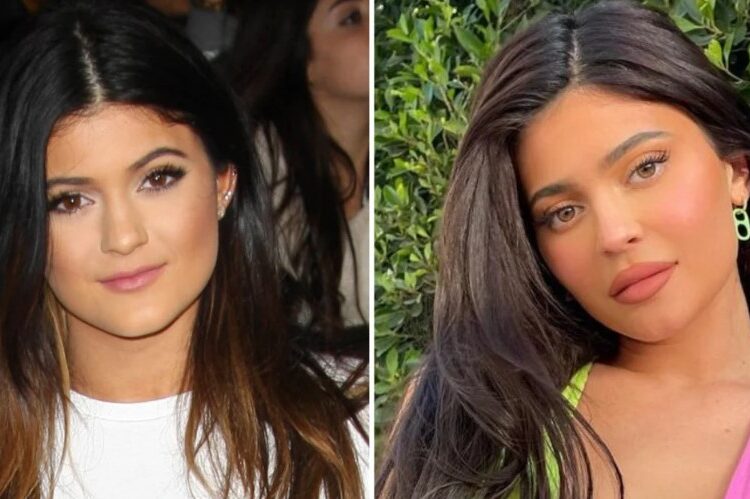 Kylie Jenner thotë se nuk ka bërë aq ndërhyrje në fytyrë sa mendojnë njerëzit: Vetëm buzët!
